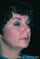 Facelift - Preop Oblique View