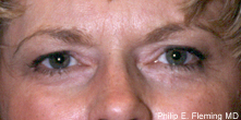 Laser Resurfacing of Face - Postop View of Eyes