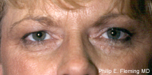 Laser Resurfacing of Face - Preop View of Eyes