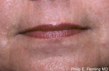 Laser Resurfacing of Face - Postop Closeup View of Mouth