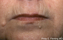 Laser Resurfacing of Face - Preop Closeup View of Mouth