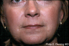 Laser Resurfacing of Face - Postop Closeup Front View