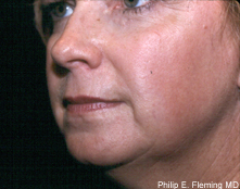 Laser Resurfacing of Face - Postop Oblique View L