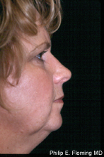 Laser Resurfacing of Face - Postop Side View