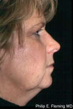 Laser Resurfacing of Face - Preop Side View