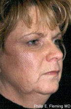 Laser Resurfacing of Face - Preop Oblique View