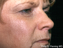 Laser Resurfacing of Face - Preop Oblique View