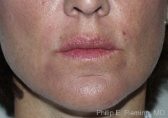 Collagen in Nasolabial Folds - 7 Days Post Treatment (Front View)