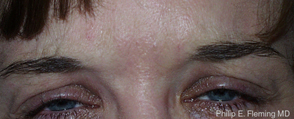 After Botox Treatment of Frown Lines - Contracted