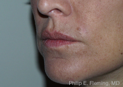 Collagen in Nasolabial Folds - 7 Days Post Treatment (Left Side)