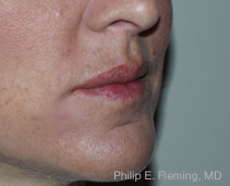 Collagen in Nasolabial Folds - 7 Days Post Treatment (Right Side)