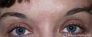 After Botox Treatment of Frown Lines - Relaxed