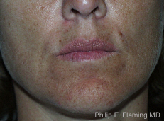 Collagen in Nasolabial Folds - Pretreatment Front View