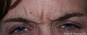 Prior to Botox Treatment of Frown Lines - Contracted