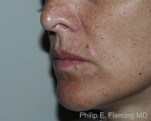 Collagen in Nasolabial Folds - Pre Treatment (Left Side)