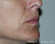 Collagen in Nasolabial Folds - Pre Treatment (Right Side)