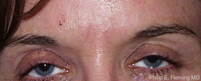 Prior to Botox Treatment of Frown Lines - Relaxed