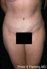 Full Abdominoplasty(AP) - 17 months postop