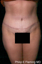 Full Abdominoplasty(AP) - 7 months postop