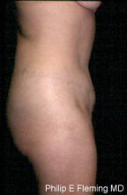 Full Abdominoplasty(RL) - 17 months postop