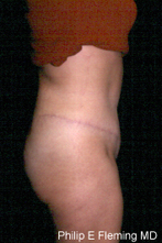 Full Abdominoplasty(RL) - 7 months postop