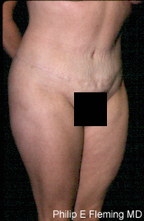 Full Abdominoplasty(RO) - 17 months postop