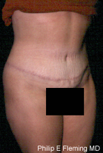 Full Abdominoplasty(RO) - 7 months postop