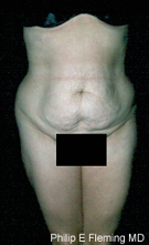 Full Abdominoplasty(AP) - Preop