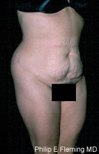 Full Abdominoplasty(RO) - Preop