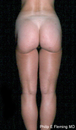 Liposuction of Outer Thighs & Inner Knees - 7 Months Postop