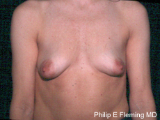 Preop Periareolar Augmentation Mastopexy AP