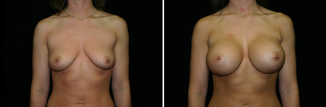 breast-aug02-01.jpg