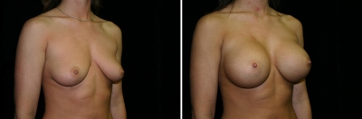 breast-aug02-02.jpg