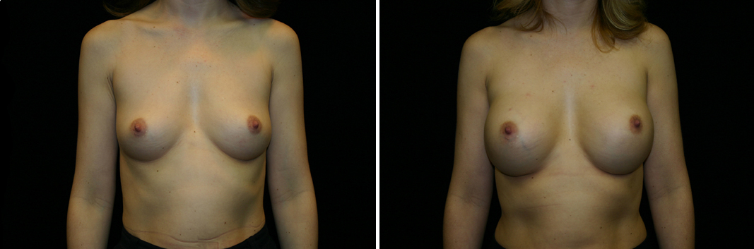 breast-aug03-01.jpg