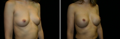 breast-aug03-02.jpg