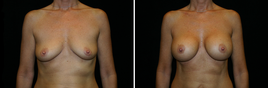 breast-aug04-01.jpg
