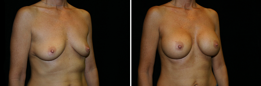 breast-aug04-02.jpg