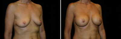 breast-aug04-02.jpg