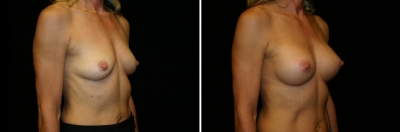 breast-aug05-2b.jpg