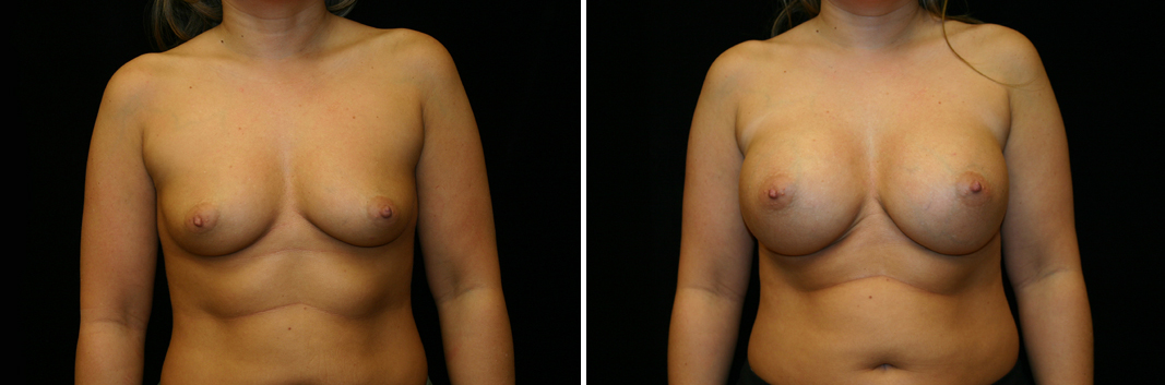 breast-aug07-01.jpg