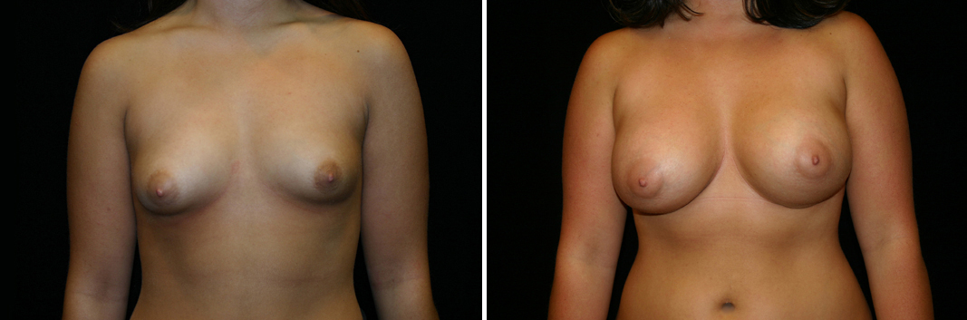 breast-aug09-01b.jpg