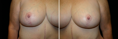 breast-mpxy02-04.jpg