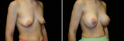 breast-mpxy-aug02-02.jpg
