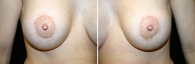 breast-mpxy-aug02-04.jpg